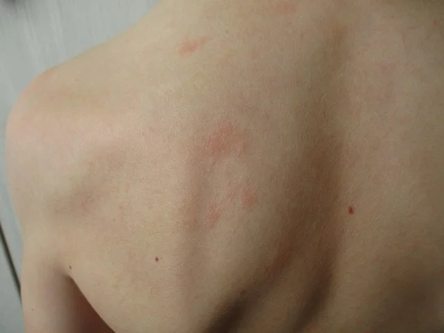 Swędząca wysypka – jak wygląda reakcja alergiczna?